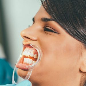 Cheek retractor in the mouth