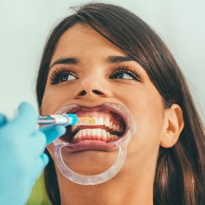Gel on the teeth