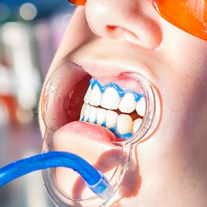 gingival mask