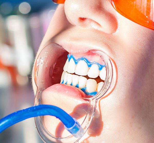 gingival mask